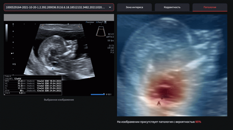 В Яндексе создали нейросеть для выявления редкой патологии на ранних сроках развития при беременности