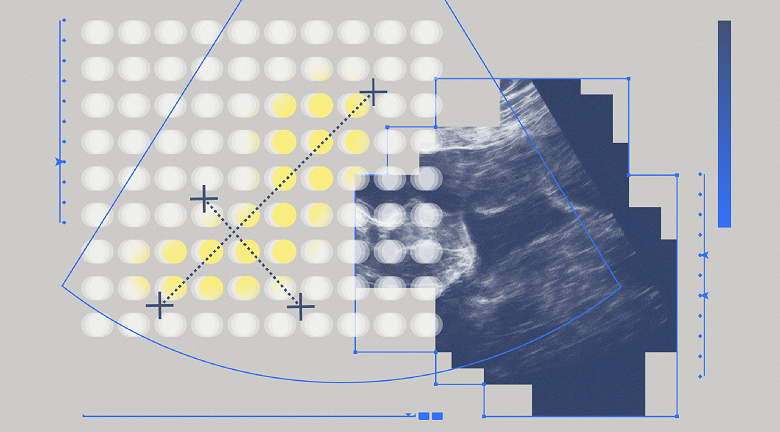 В Яндексе создали нейросеть для выявления редкой патологии на ранних сроках развития при беременности